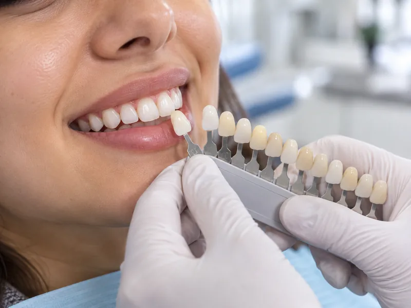 Dental Crowns & Caps at Kleem Dental Universe, Gajularamaram